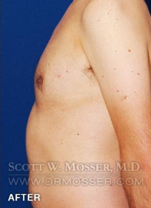 Liposuction - Chest Patient 34240 After Photo # 4