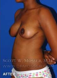 Breast Lift Without Implants Patient 55667 After Photo # 6