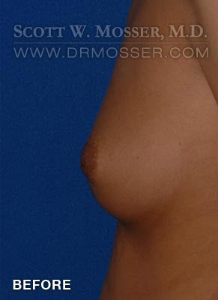 Nipple Inversion Correction Patient 38571 Before Photo # 5
