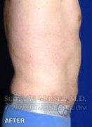 Liposuction - Abdomen & Flanks Patient 64992 After Photo Thumbnail # 8