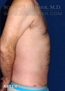 Liposuction - Abdomen & Flanks Patient 23232 After Photo Thumbnail # 12