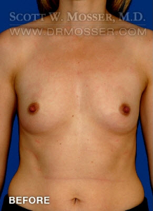 Breast Augmentation Patient 51986 Before Photo # 1