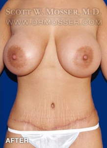 Mommy Makeover Patient 49956 After Photo # 2