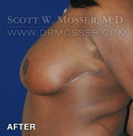 Breast Reduction Patient 70589 After Photo # 6