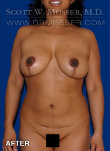 Liposuction - Abdomen & Flanks Patient 36564 After Photo # 2