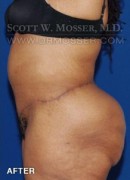 Lower Body Lift Patient 16603 After Photo Thumbnail # 6