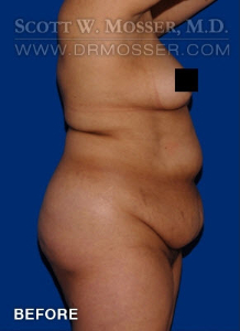 Liposuction - Abdomen & Flanks Patient 39968 Before Photo # 3
