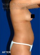 Liposuction - Abdomen & Flanks Patient 53811 After Photo Thumbnail # 6