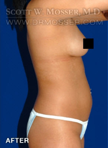 Liposuction - Abdomen & Flanks Patient 53811 After Photo # 6