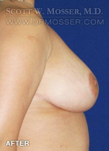 Breast Reduction Patient 54903 After Photo # 4