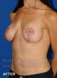 Breast Lift With Implants Patient 19074 After Photo # 6