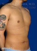 Liposuction - Chest Patient 38439 Before Photo Thumbnail # 3