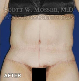 Abdominoplasty Patient 90208 After Photo # 2