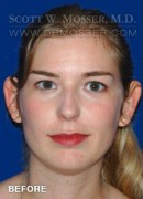 Otoplasty Patient 99547 Before Photo Thumbnail # 1