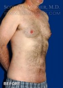 Liposuction - Abdomen & Flanks Patient 23232 Before Photo Thumbnail # 9