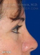 Upper Blepharoplasty Patient 79210 After Photo Thumbnail # 6