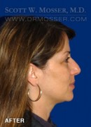 Upper Blepharoplasty Patient 94858 After Photo Thumbnail # 6