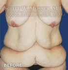 Abdominoplasty Patient 90208 Before Photo Thumbnail # 1
