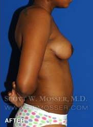 Breast Lift Without Implants Patient 55667 After Photo # 8