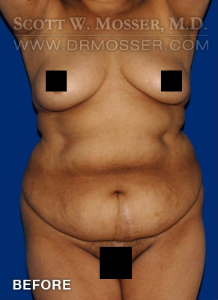 Liposuction - Abdomen & Flanks Patient 39968 Before Photo # 1
