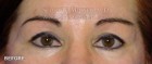 Upper Blepharoplasty Patient 79210 Before Photo Thumbnail # 1