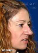 Upper Blepharoplasty Patient 26830 Before Photo Thumbnail # 3