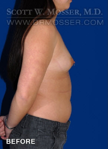 Breast Augmentation Patient 59926 Before Photo # 5