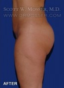 Brazilian Butt Lift Patient 32708 After Photo Thumbnail # 4