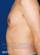 Liposuction - Chest Patient 34240 Before Photo Thumbnail # 3