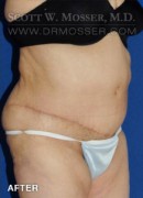 Abdominoplasty Patient 72192 After Photo Thumbnail # 6