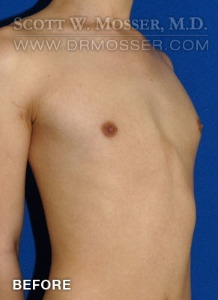 Breast Augmentation Patient 50236 Before Photo # 3