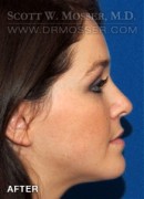 Liposuction - Face Patient 40198 After Photo Thumbnail # 6