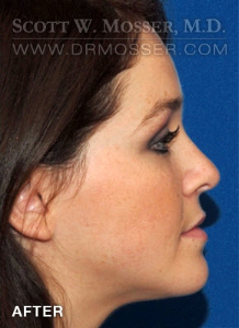 Liposuction - Face Patient 40198 After Photo # 6