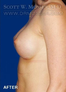 Breast Augmentation Patient 41756 After Photo # 6