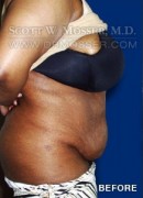 Abdominoplasty Patient 30014 Before Photo Thumbnail # 5