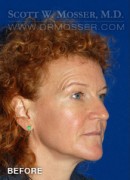 Upper Blepharoplasty Patient 45312 Before Photo Thumbnail # 3