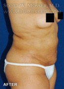 Liposuction - Abdomen & Flanks Patient 51266 After Photo Thumbnail # 4