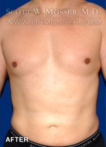 Liposuction - Chest Patient 10587 After Photo # 2