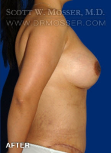 Breast Augmentation Patient 27533 After Photo # 4