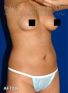 Liposuction - Abdomen & Flanks Patient 53811 After Photo # 4