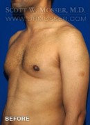 Liposuction - Chest Patient 51091 Before Photo Thumbnail # 5