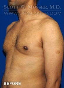Liposuction - Chest Patient 51091 Before Photo # 5