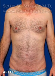 Liposuction - Abdomen & Flanks Patient 23232 After Photo # 8