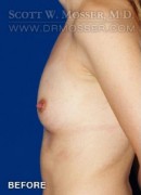 Breast Augmentation Patient 10196 Before Photo Thumbnail # 5
