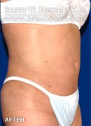 Liposuction - Abdomen & Flanks Patient 68884 After Photo Thumbnail # 4