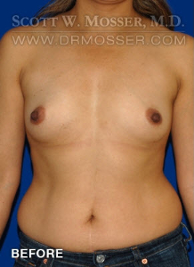 Breast Augmentation Patient 47902 Before Photo # 1