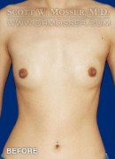 Breast Augmentation Patient 25809 Before Photo Thumbnail # 1