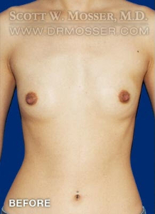 Breast Augmentation Patient 25809 Before Photo # 1