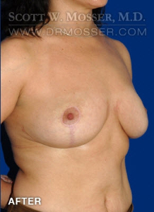 Breast Reduction Patient 13262 After Photo # 4