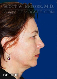 Chin Implant Patient 16572 Before Photo # 9